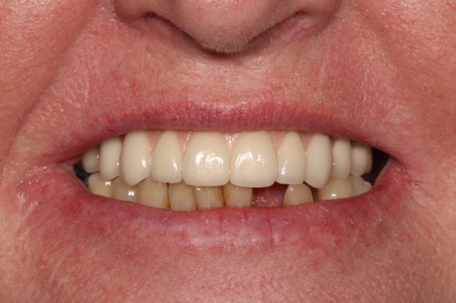 After - All on 4 Kent Dental