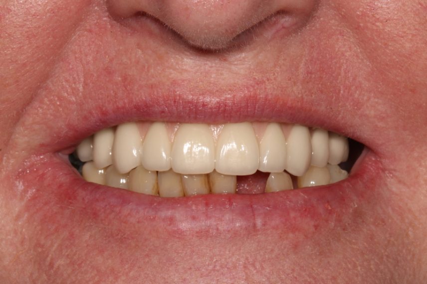 After - All on 4 Kent Dental