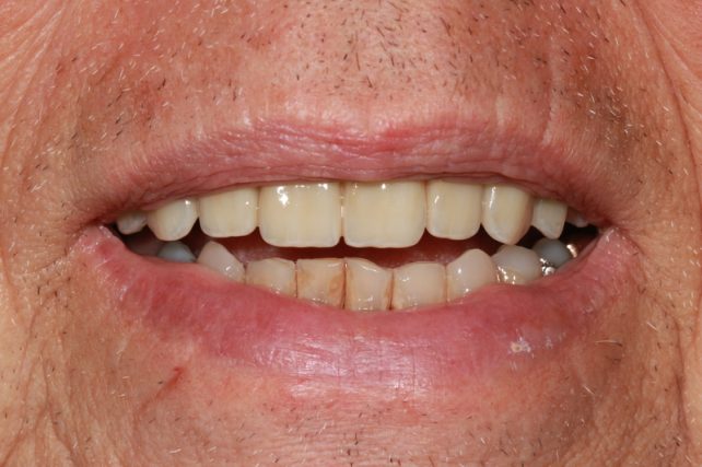 After - All on 4 Kent Dental