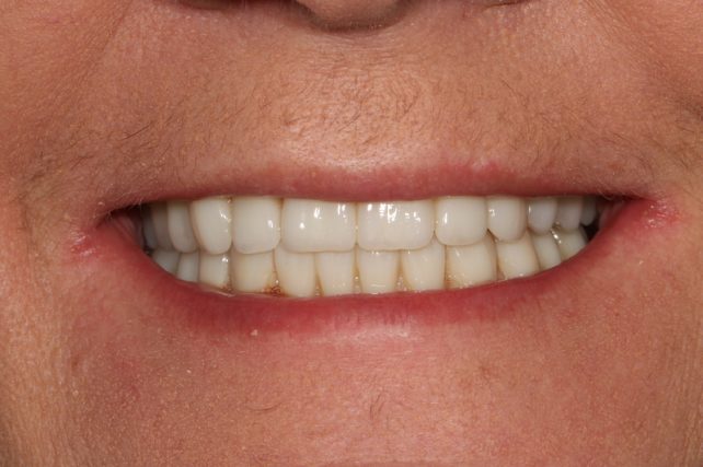 After - All on 4 Kent Dental