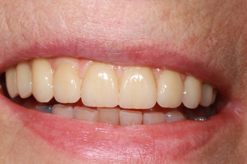 After - All on 4 Kent Dental