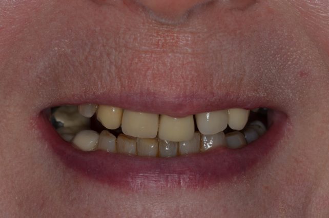 Before - All on 4 Kent Dental