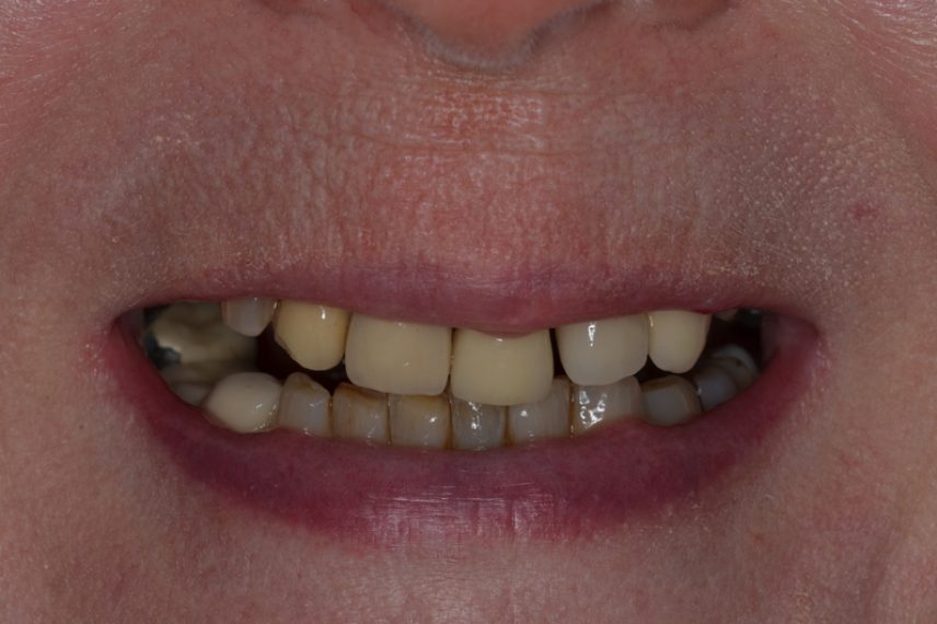 Before - All on 4 Kent Dental