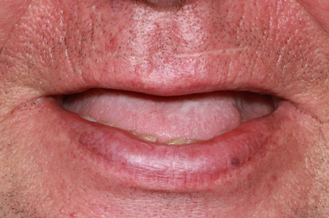 Before - All on 4 Kent Dental