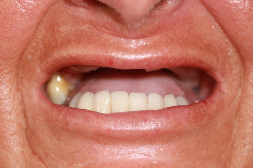 Before - All on 4 Kent Dental