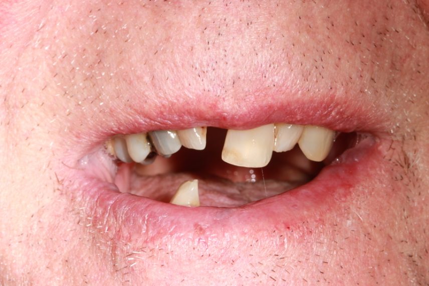 Before - All on 4 Kent Dental