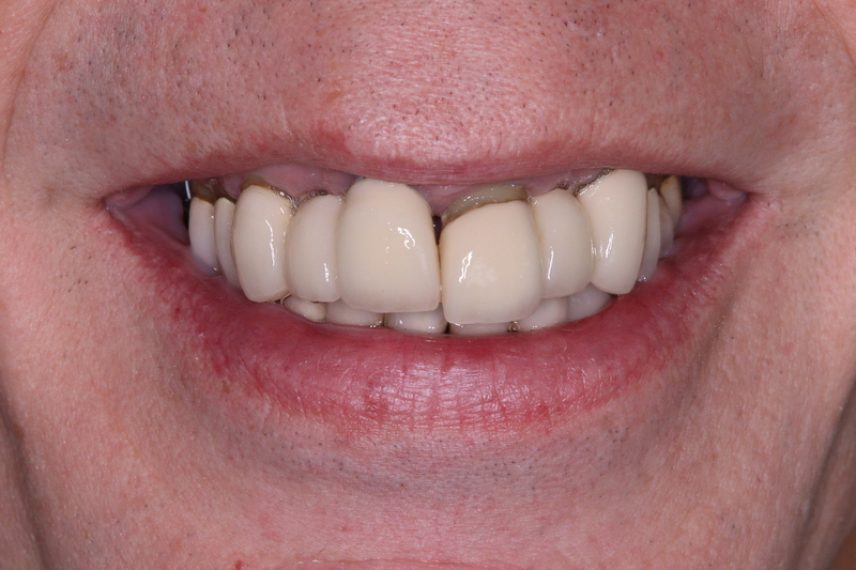 Before - All on 4 Kent Dental