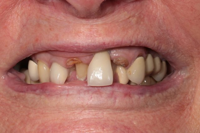 Before - All on 4 Kent Dental