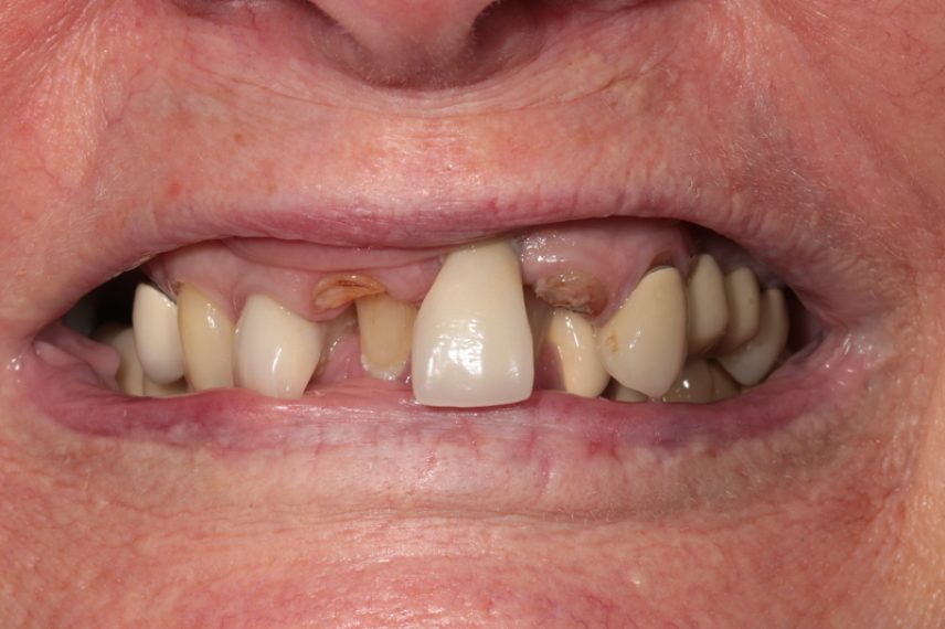 Before - All on 4 Kent Dental