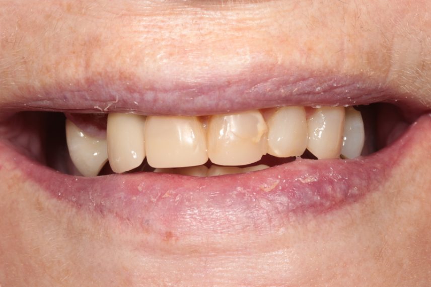 Before - All on 4 Kent Dental