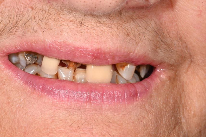 Before - All on 4 Kent Dental