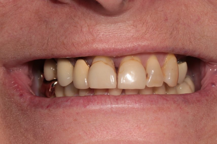 Before - All on 4 Kent Dental