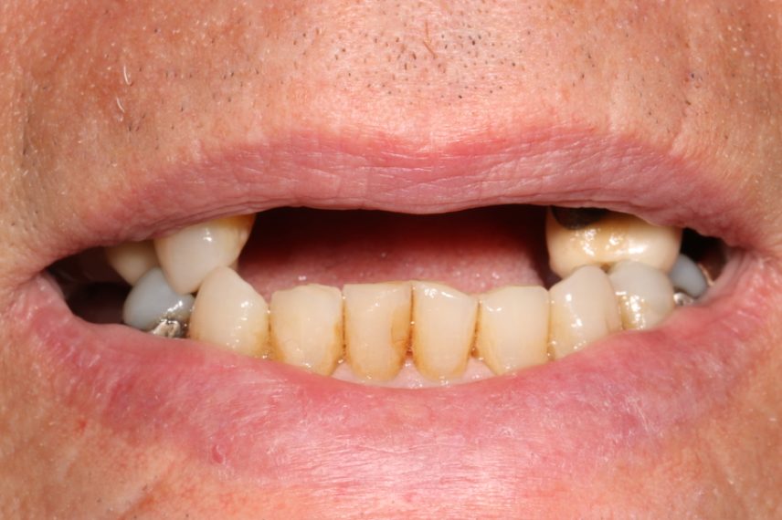 Before - All on 4 Kent Dental