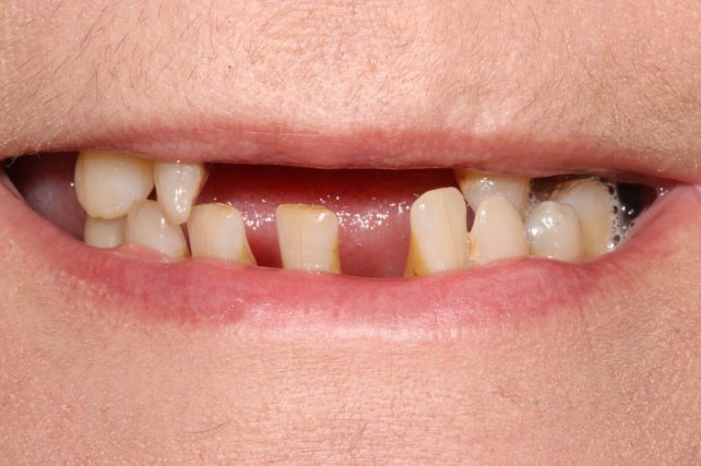 Before - All on 4 Kent Dental