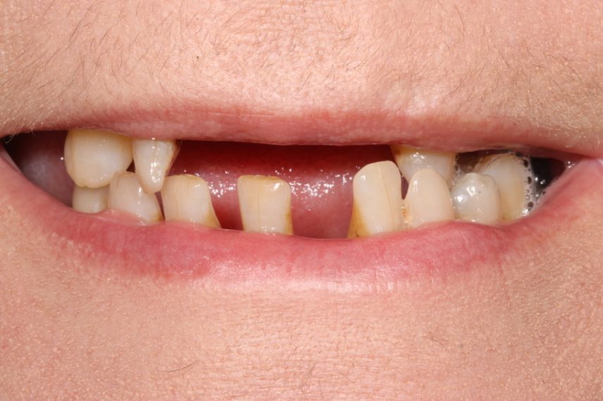 Before - All on 4 Kent Dental