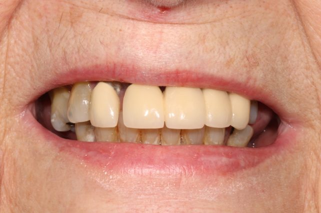 Before - All on 4 Kent Dental