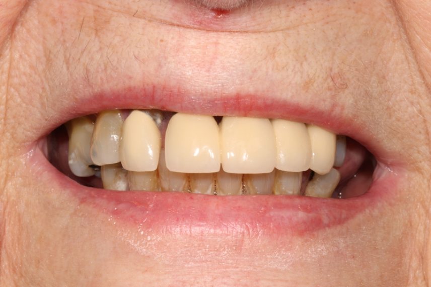 Before - All on 4 Kent Dental