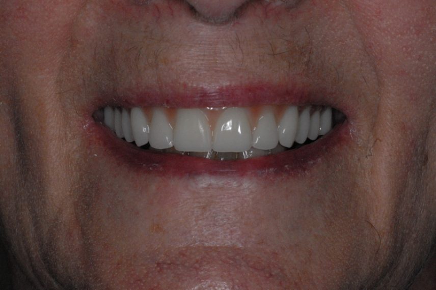 After - All on 4 Kent Dental