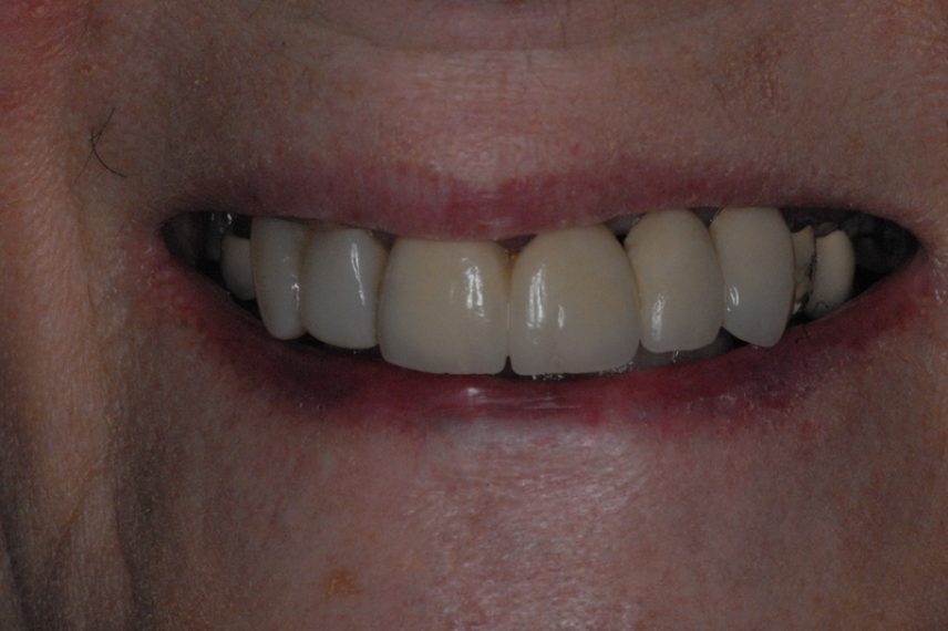 Before - All on 4 Kent Dental
